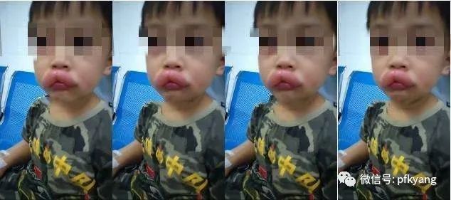 男孩吃葡萄過敏腫成嘟嘟嘴怎么回事？畫面詳情曝光網(wǎng)友忍不住笑了(圖2)